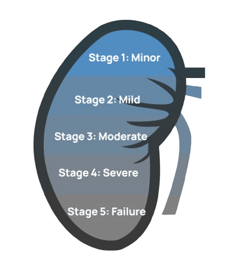 Kidney Stages Diagram